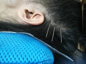 側頭筋への刺鍼